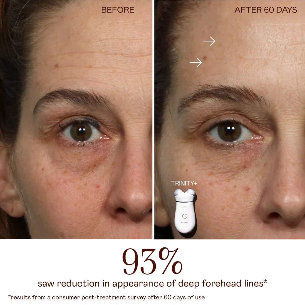 NuFace Trinity + PRO with ELE (Effective Eye + Lip Attachment)